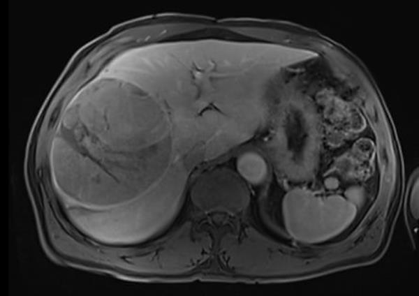 An MRI scan of Barrie Tibbetts’ rare tumour.